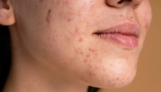 Hormonale acne en manieren om het te behandelen