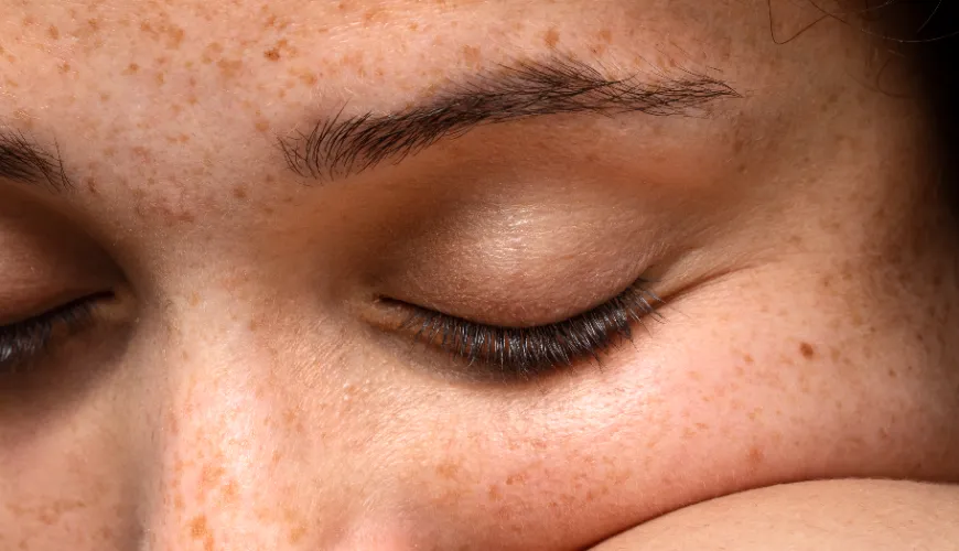 Waarom ontstaan er bruine vlekken op de huid en hoe kunt u ze voorkomen?